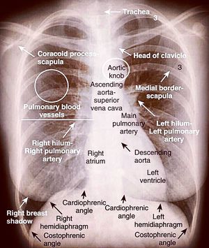 Cxr Interpretation - Medizzy