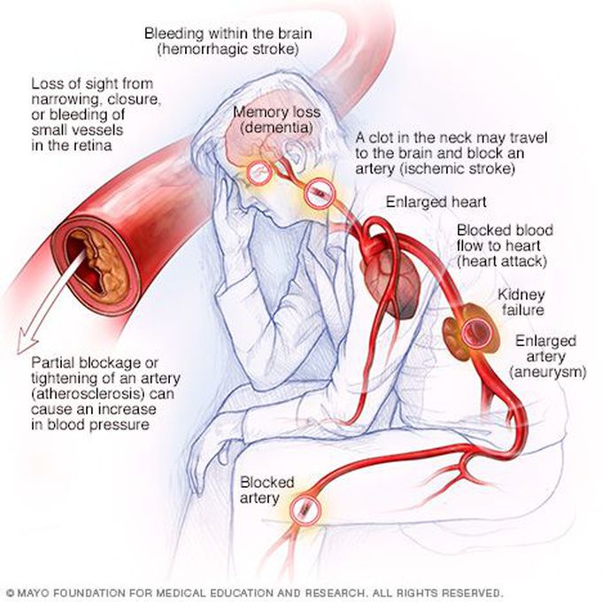 Consquence of High Blood Pressure