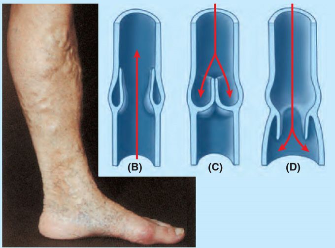 Varicose Veins, Thrombosis, and Thrombophlebitis