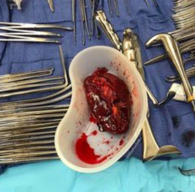 Injured spleen