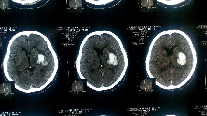 Head ct scan