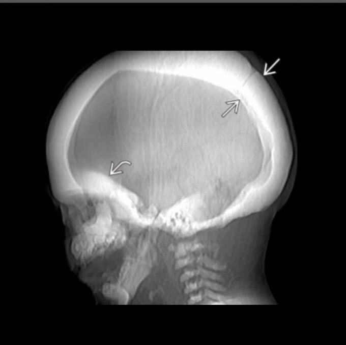Albers Schönberg disease?                                            Stone bone/ marble bone disease, characterized by sclerosis , mainly involving spline , pelvis abd skull base paradoxical fragility of bones. Due to mutation of CLCN7 gene.