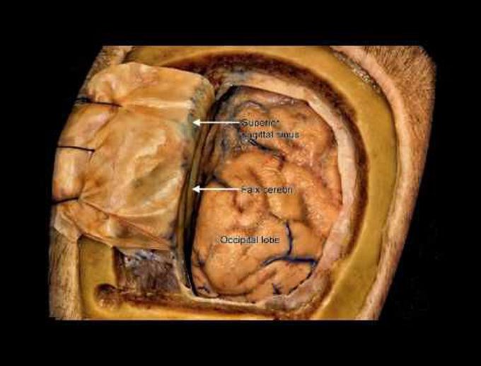 Resection of complex occipital AVM with giant varix: demonstration of microsurgical technique