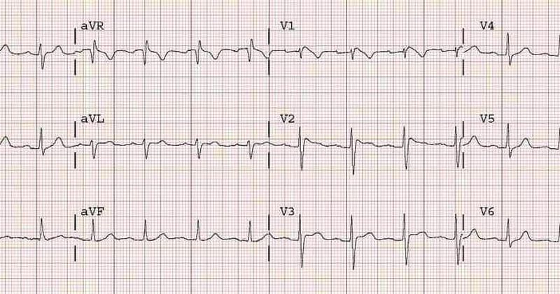 Brugada syndrome - MEDizzy