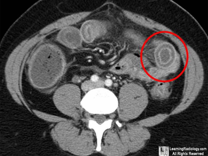 The name of this sign on CT scan is target sign