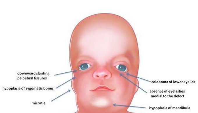 These are the symptoms of Franceschetti Klein syndrome