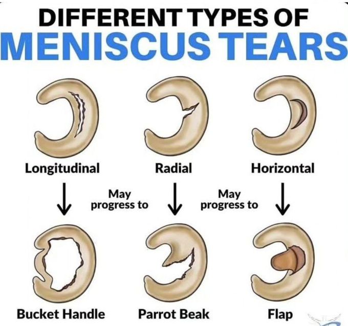 Meniscus Tears - MEDizzy