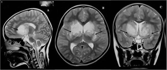 Extreme Sexual Behavior, Hypermetamorphosis, and  Memory Loss: Klüver-Bucy Syndrome