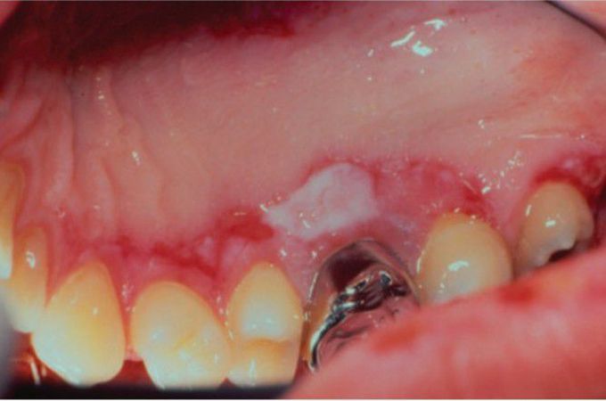 Systemic lupus erythmatosus