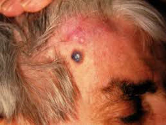 Angiosarcoma - MEDizzy