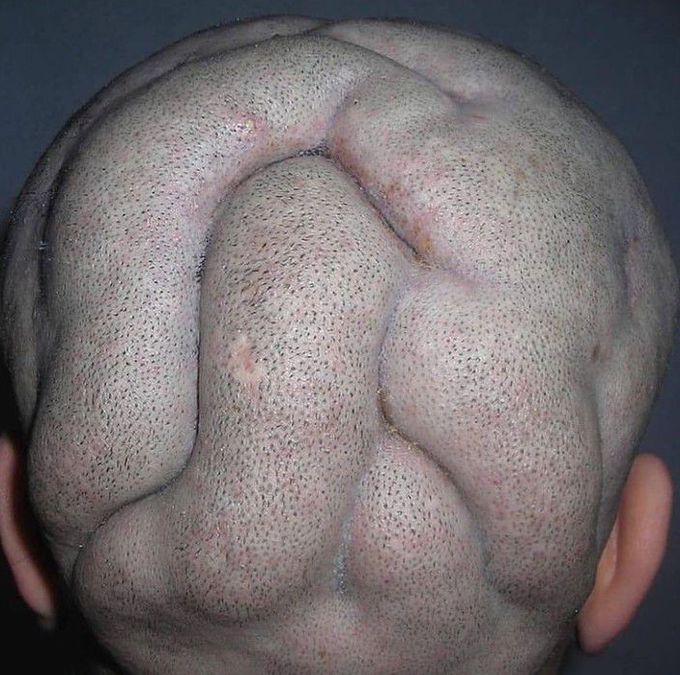 BULLDOG SCALP SYNDROME