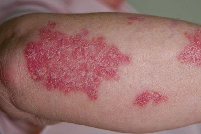 PSORIASIS VULGARIS