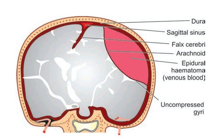 Subdural haematoma