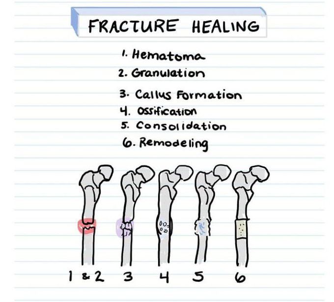 Fracture healing