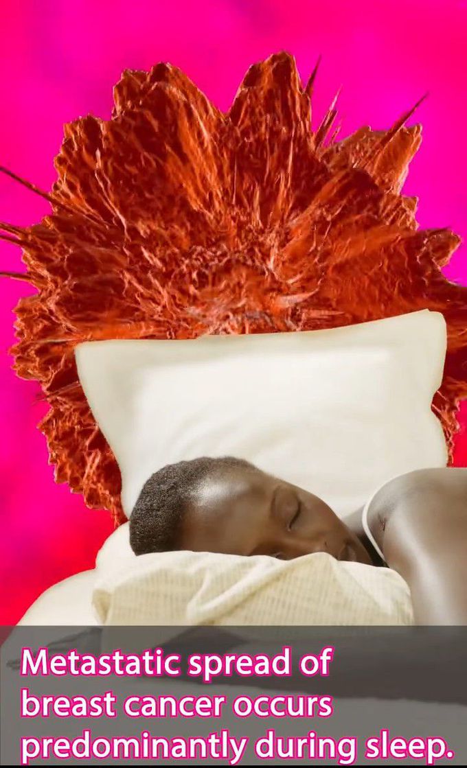 Breast cancer-Metastatic spread during sleep