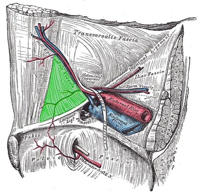 Where Direct Hernias Bulge Out