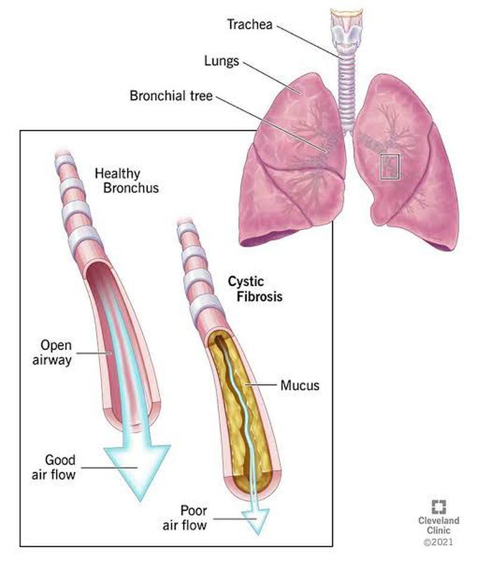 Cystic Fibrosis