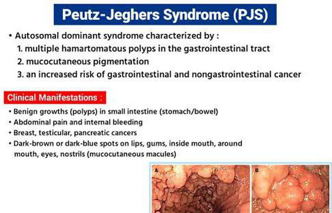 These are the clinical manifestations of Peutz Jeghers Syndyome