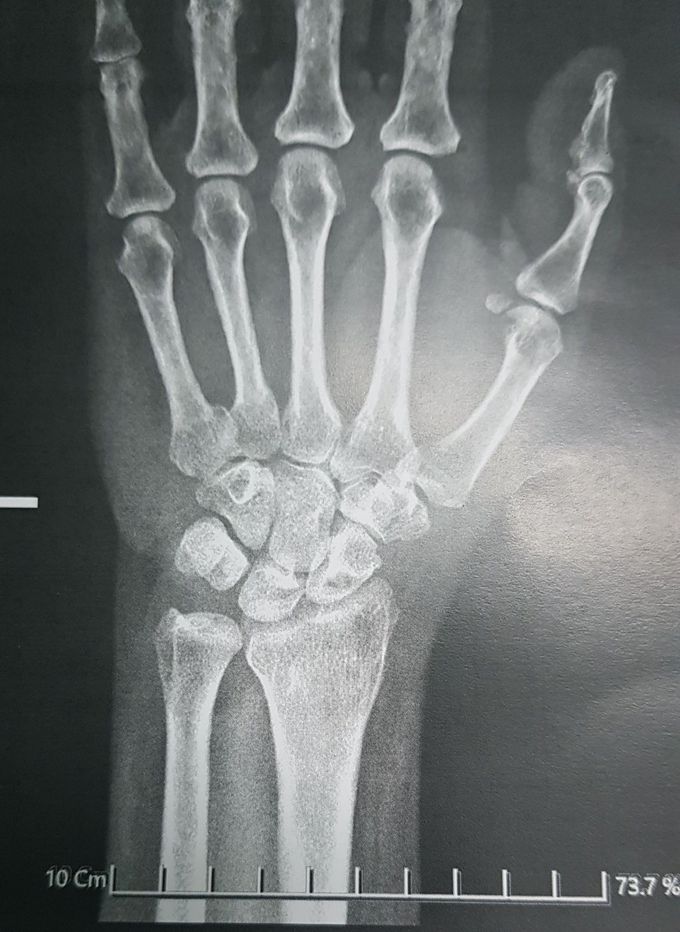 Hand truma
