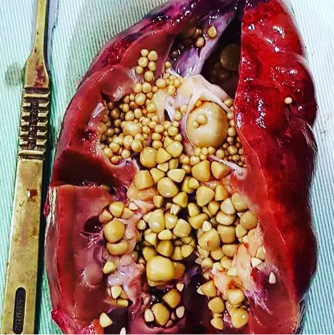 Kidney Stones