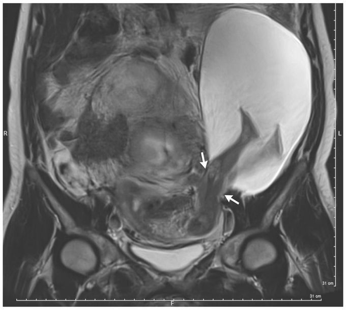 Uterine Rupture with Protruded Legs in a Large Amniocele