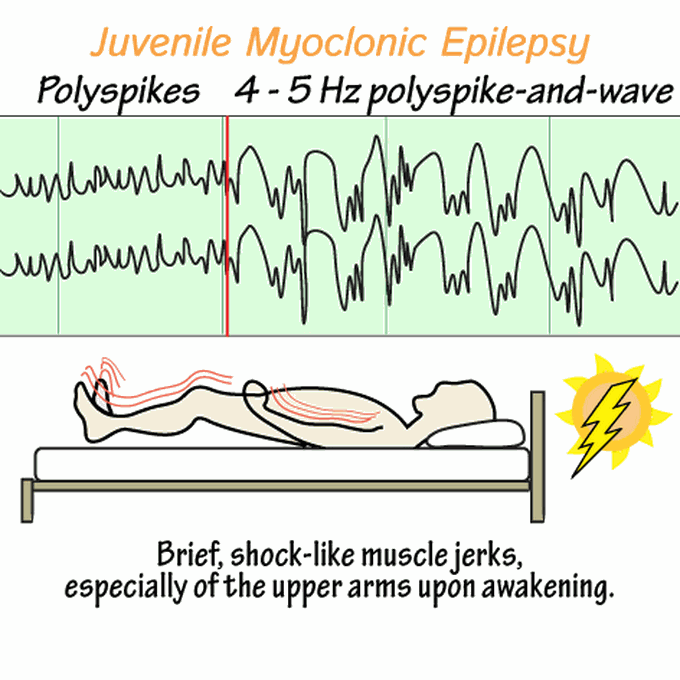 Juvenile myoclonic epilepsy