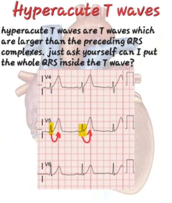 Hyperacute T Wave