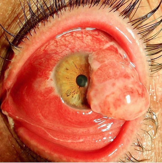 Up close view of a malignant tumor of the eye!  