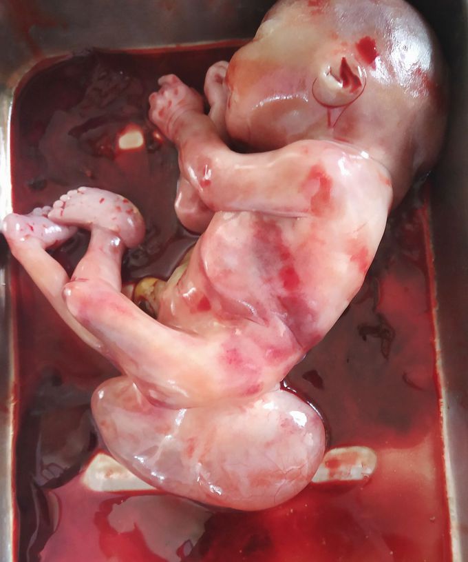 Sacrococcygeal teratoma