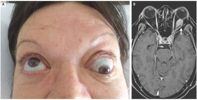 Orbital Metastasis in Breast Cancer