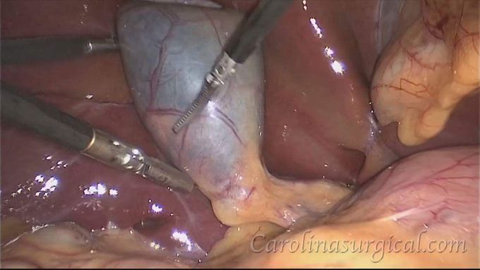 Gall bladder removal surgery