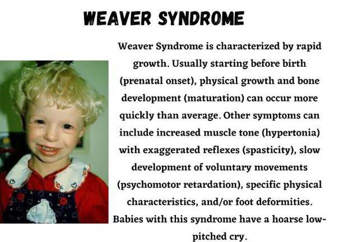 These are the symptoms of Weaver syndrome