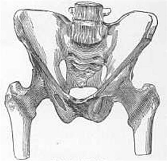 Roberts pelvis