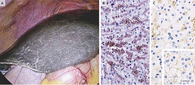 Dubin–Johnson Syndrome