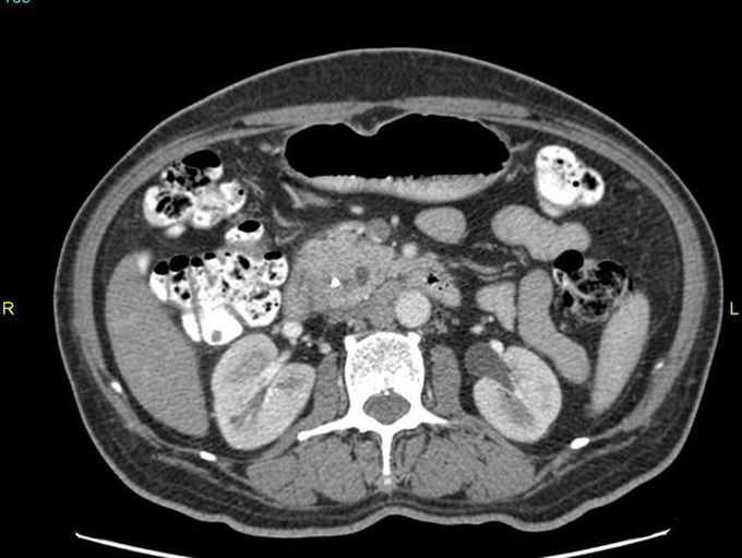 Pancreatic Divisum