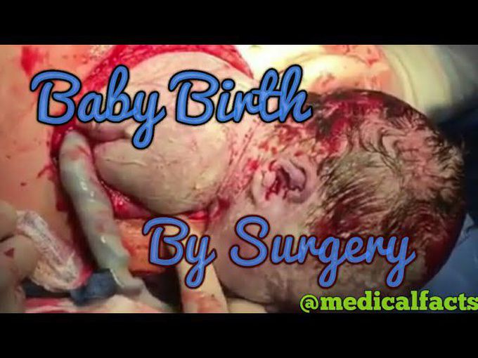 Baby Birth Surgery Delivery (Operation) by medical facts