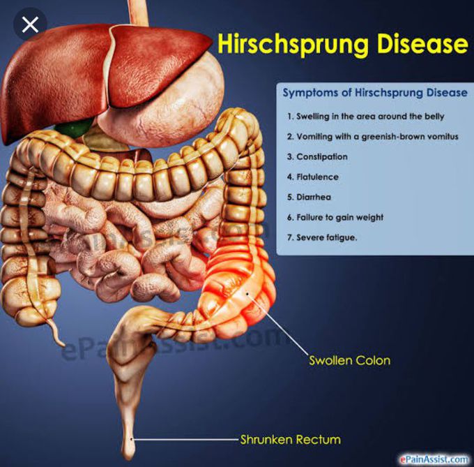 Hirsprung disease