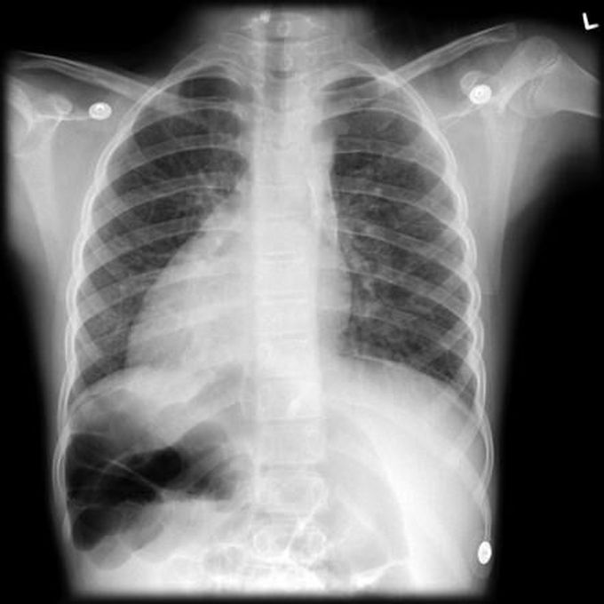 Dextrocardia