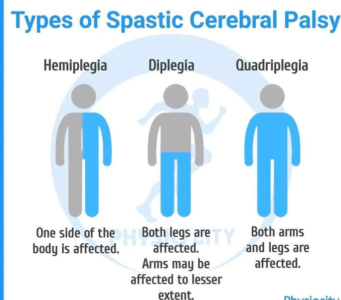 Types of Spastic CP