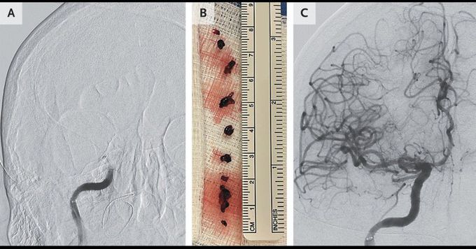 Thrombectomy in Acute Ischemic Stroke