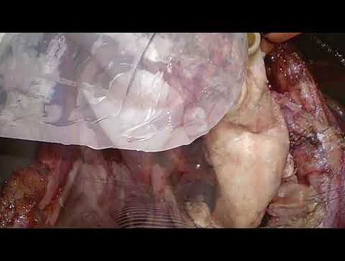 Homograft Repair of Aortic Root Abscess in Prosthetic Valve Endocarditis