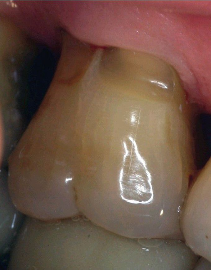 Cervical Enamel Extension