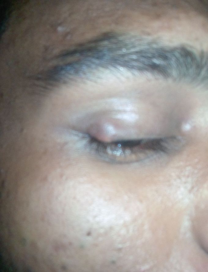 Eyelead swelling