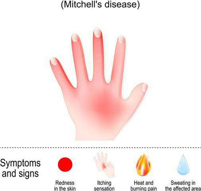 These are the symptoms of Mitchell's syndrome