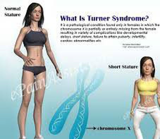 women with turner syndrome