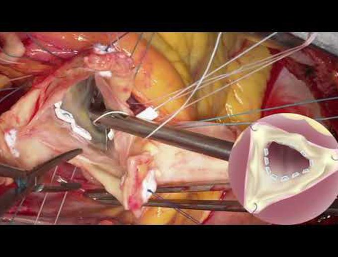 Repair of Type A Aortic Dissection