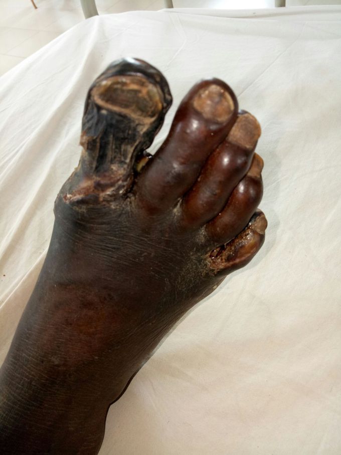 Peripheral vascular disease
