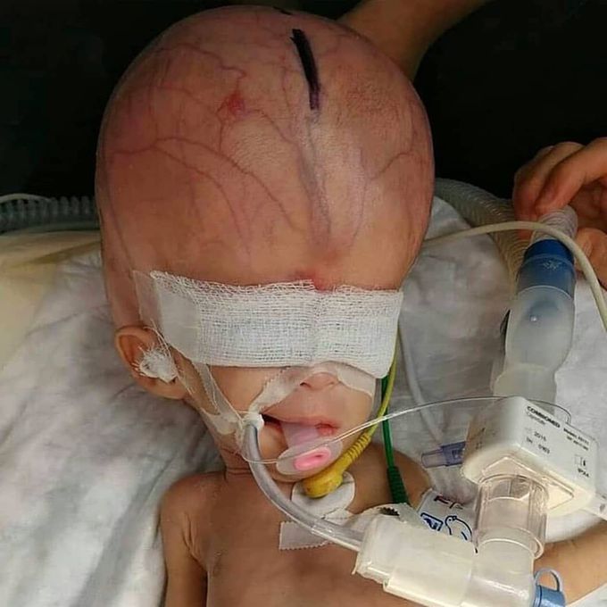 Extreme case of hydrocephalus in a pediatric patient! 