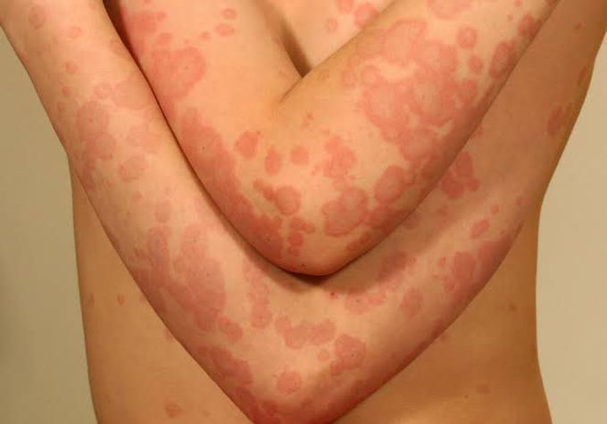 Treatment of erythema multiforme