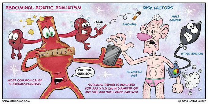Abdominal Aortic Aneurysm